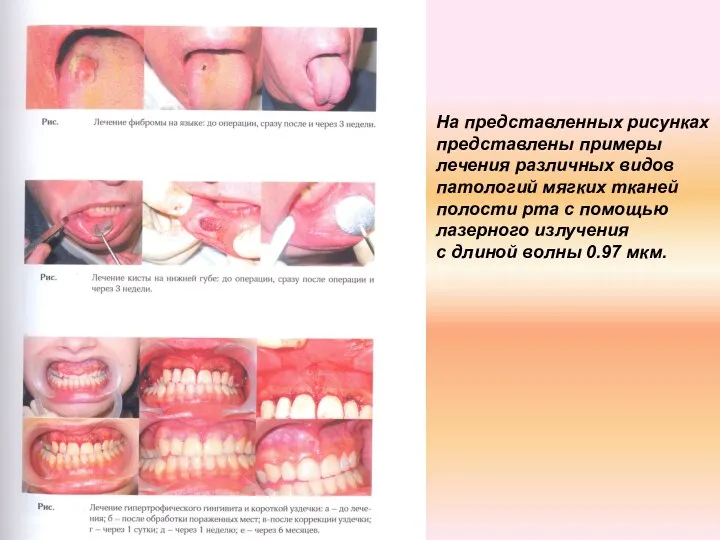 На представленных рисунках представлены примеры лечения различных видов патологий мягких тканей полости рта