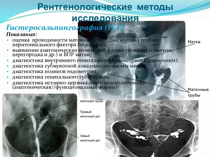 Рентгенологические методы исследования Гистеросальпингография (ГСГ) Показания: оценка проходимости маточных труб