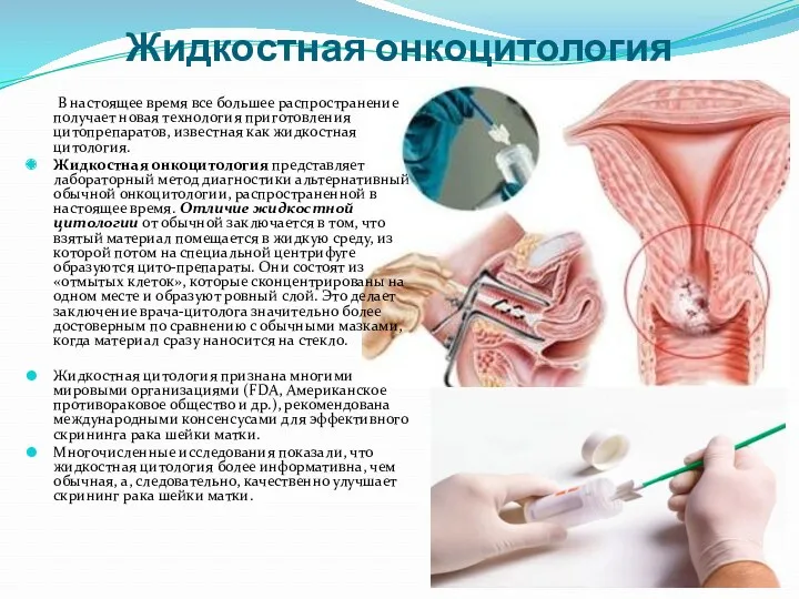 Жидкостная онкоцитология В настоящее время все большее распространение получает новая