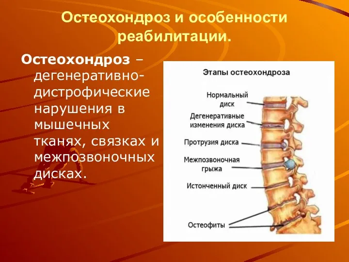 Остеохондроз и особенности реабилитации. Остеохондроз –дегенеративно-дистрофические нарушения в мышечных тканях, связках и межпозвоночных дисках.