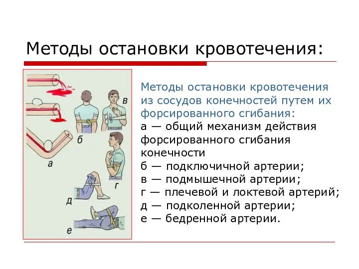 Методы остановки кровотечения: Методы остановки кровотечения из сосудов конечностей путем их форсированного сгибания: