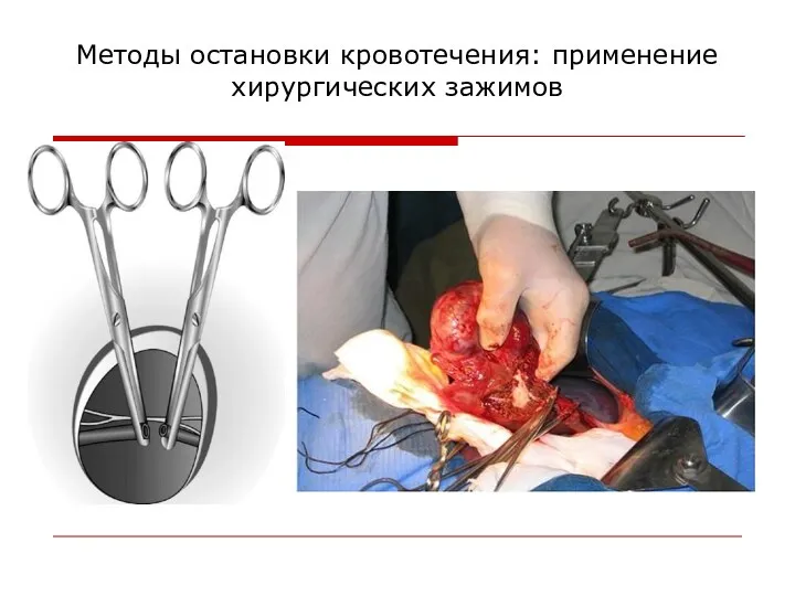 Методы остановки кровотечения: применение хирургических зажимов