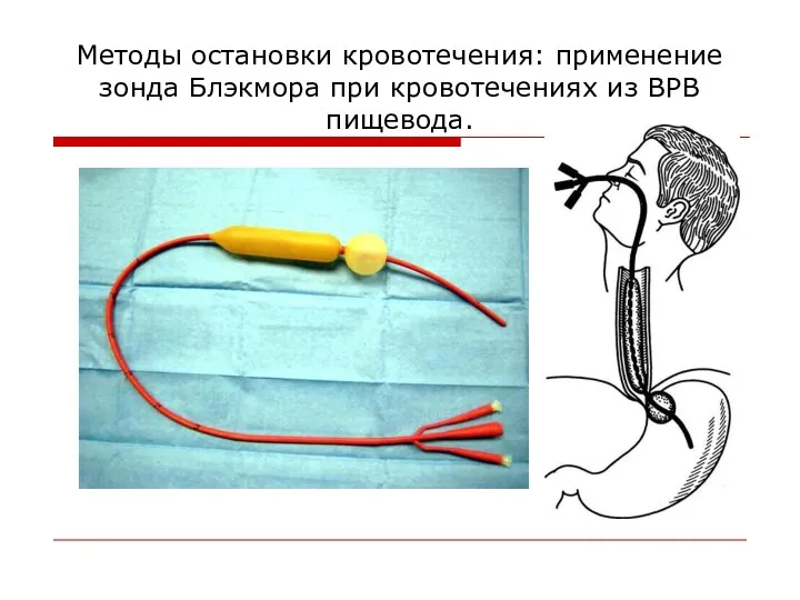 Методы остановки кровотечения: применение зонда Блэкмора при кровотечениях из ВРВ пищевода.