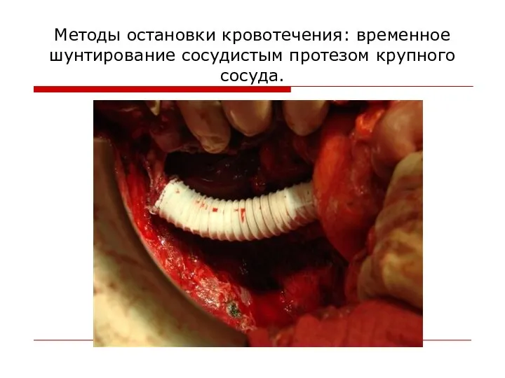 Методы остановки кровотечения: временное шунтирование сосудистым протезом крупного сосуда.