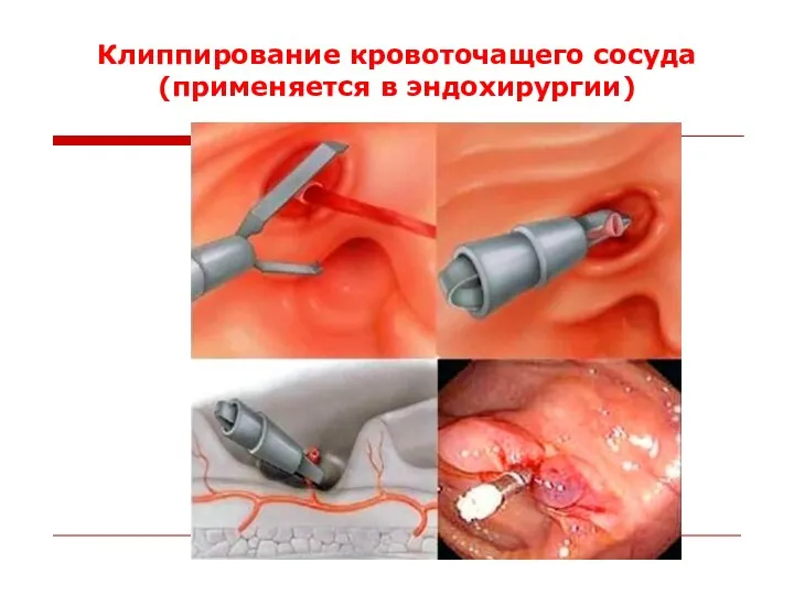 Клиппирование кровоточащего сосуда (применяется в эндохирургии)