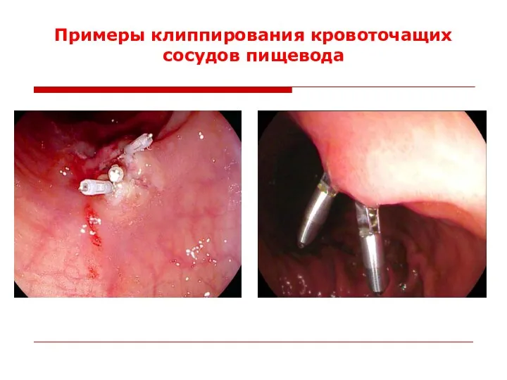 Примеры клиппирования кровоточащих сосудов пищевода