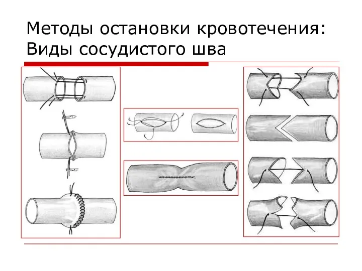 Методы остановки кровотечения: Виды сосудистого шва