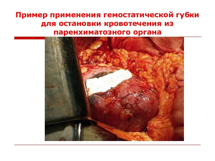Пример применения гемостатической губки для остановки кровотечения из паренхиматозного органа