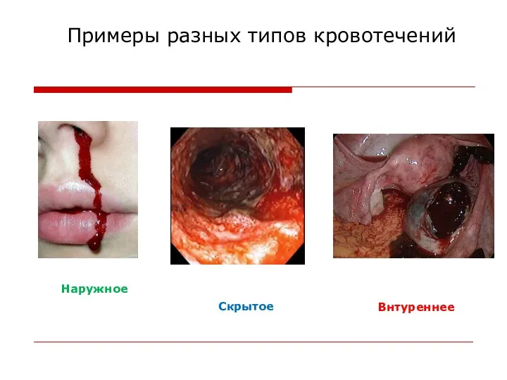 Примеры разных типов кровотечений Наружное Скрытое Внтуреннее