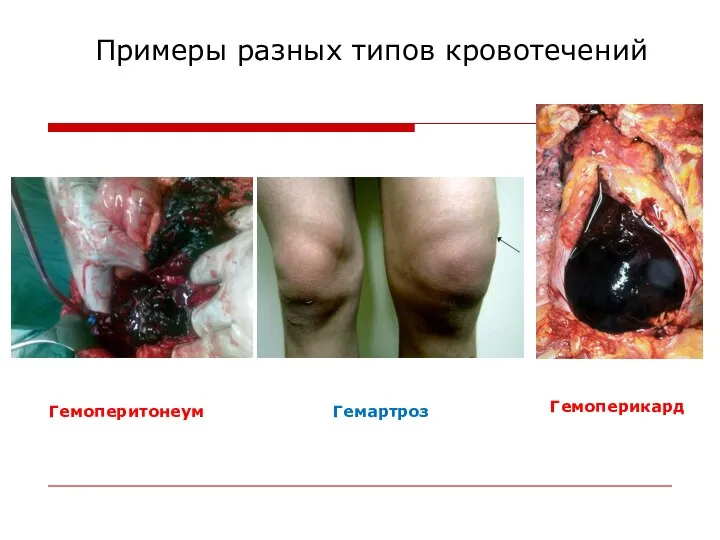 Примеры разных типов кровотечений Гемоперитонеум Гемартроз Гемоперикард