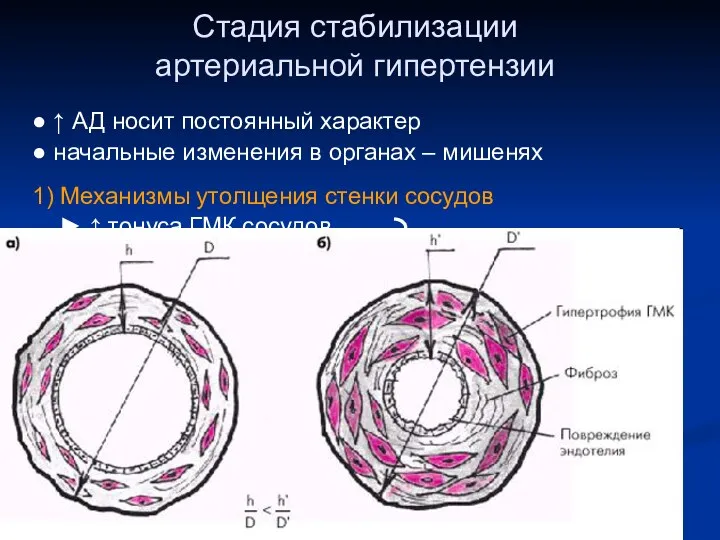 Стадия стабилизации артериальной гипертензии ● ↑ АД носит постоянный характер