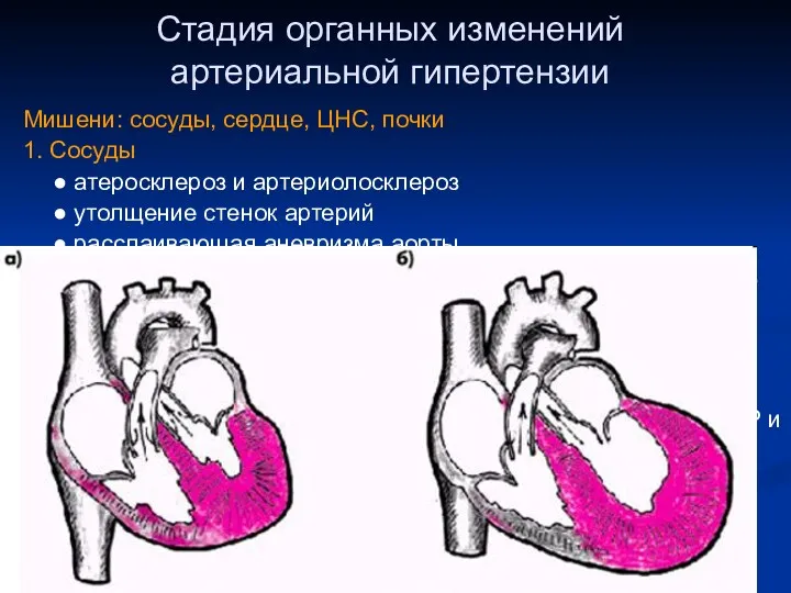 Стадия органных изменений артериальной гипертензии Мишени: сосуды, сердце, ЦНС, почки