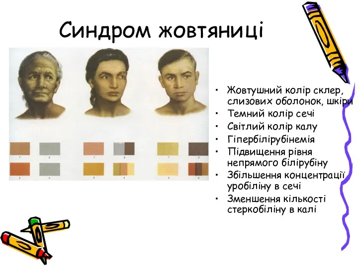 Синдром жовтяниці Жовтушний колір склер, слизових оболонок, шкіри Темний колір