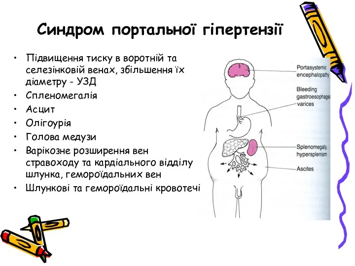 Синдром портальної гіпертензії Підвищення тиску в воротній та селезінковій венах,