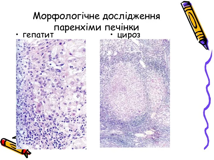 Морфологічне дослідження паренхіми печінки гепатит цироз