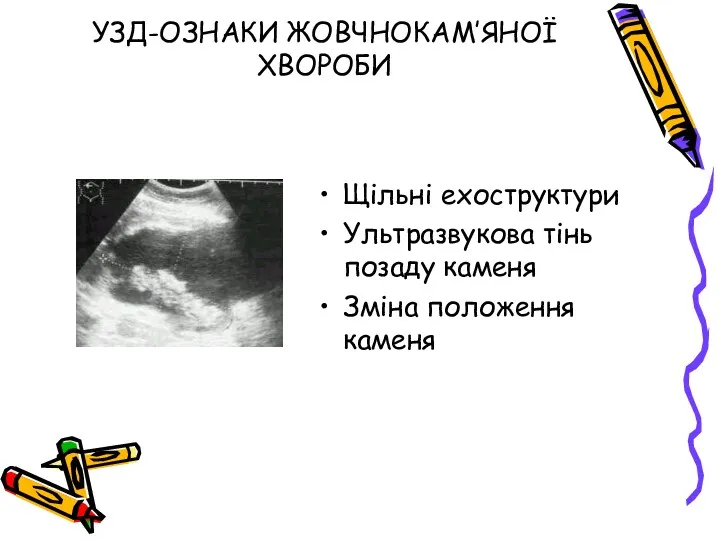 УЗД-ОЗНАКИ ЖОВЧНОКАМ’ЯНОЇ ХВОРОБИ Щільні ехоструктури Ультразвукова тінь позаду каменя Зміна положення каменя