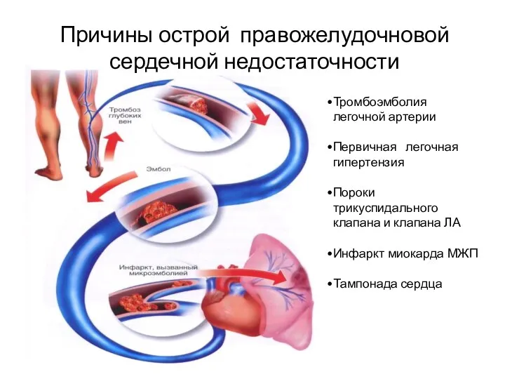 Тромбоэмболия легочной артерии Первичная легочная гипертензия Пороки трикуспидального клапана и