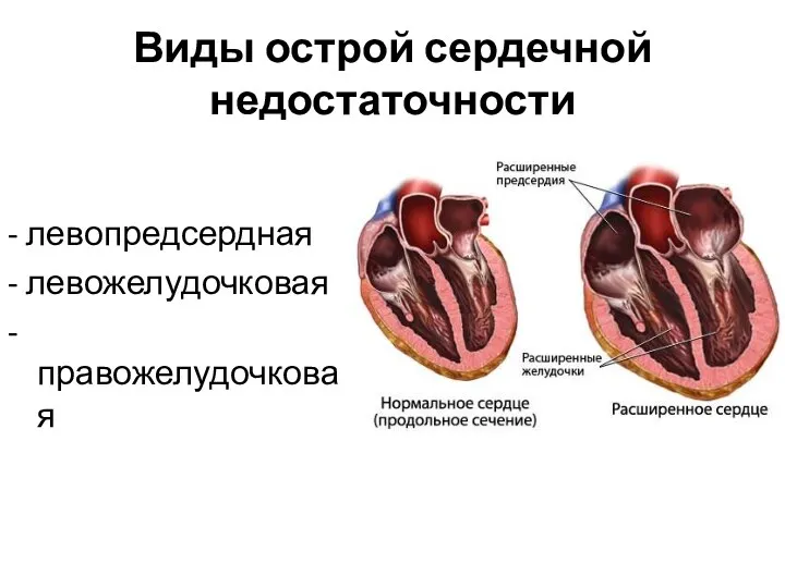 Виды острой сердечной недостаточности - левопредсердная - левожелудочковая - правожелудочковая