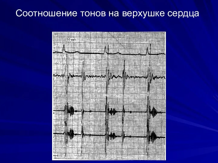 Соотношение тонов на верхушке сердца