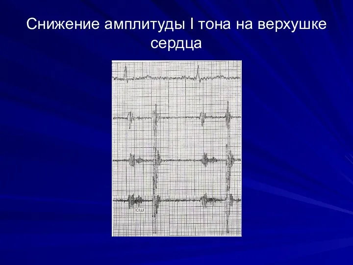 Снижение амплитуды I тона на верхушке сердца