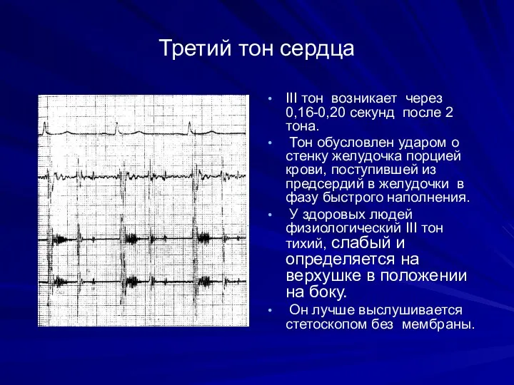 Третий тон сердца III тон возникает через 0,16-0,20 секунд после 2 тона. Тон