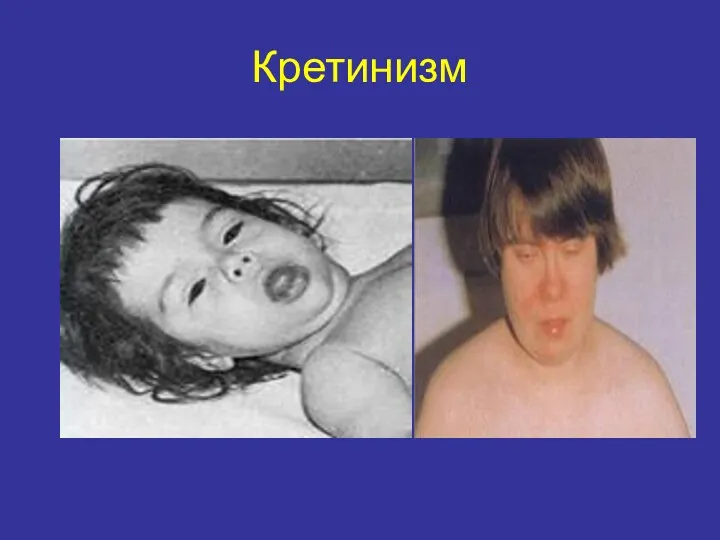 Кретинизм