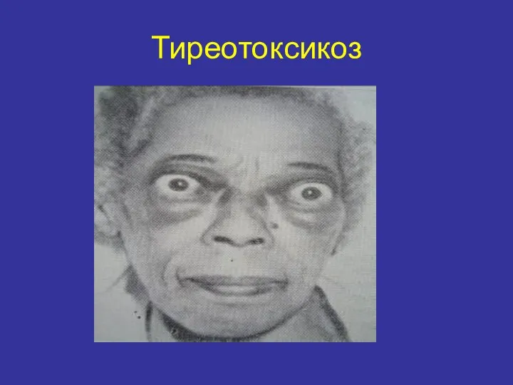 Тиреотоксикоз