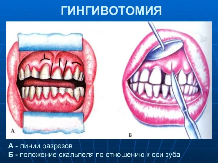 ГИНГИВОТОМИЯ А - линии разрезов Б - положение скальпеля по отношению к оси зуба
