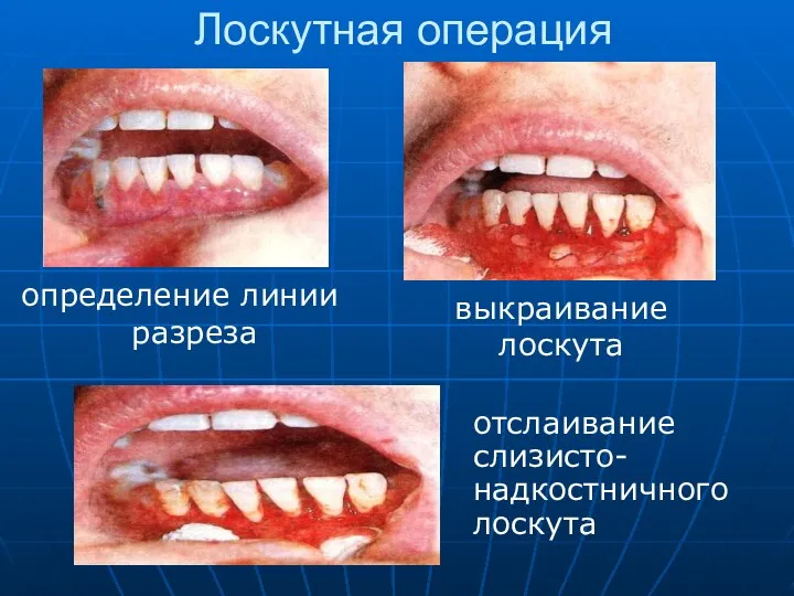 Лоскутная операция определение линии разреза выкраивание лоскута отслаивание слизисто-надкостничного лоскута