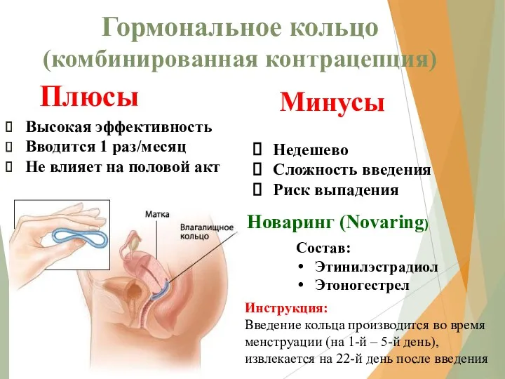 Гормональное кольцо (комбинированная контрацепция) Плюсы Высокая эффективность Вводится 1 раз/месяц Не влияет на