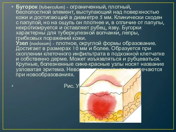 Бугорок (tuberculum) - ограниченный, плотный, бесполостной элемент, выступающий над поверхностью