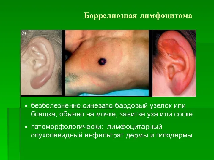 Боррелиозная лимфоцитома безболезненно синевато-бардовый узелок или бляшка, обычно на мочке, завитке уха или