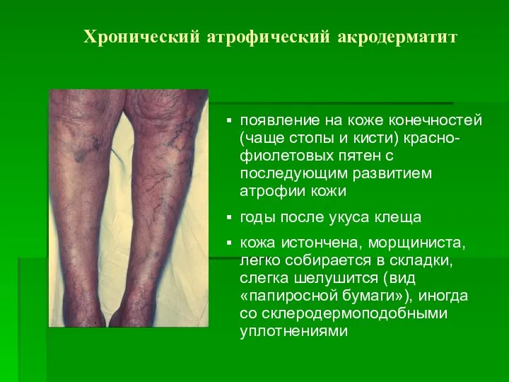 Хронический атрофический акродерматит появление на коже конечностей (чаще стопы и кисти) красно-фиолетовых пятен