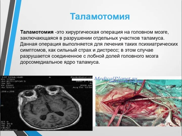 Таламотомия -это хирургическая операция на головном мозге, заключающаяся в разрушении