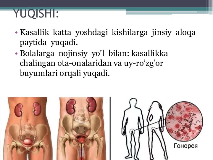 YUQISHI: Kasallik katta yoshdagi kishilarga jinsiy aloqa paytida yuqadi. Bolalarga