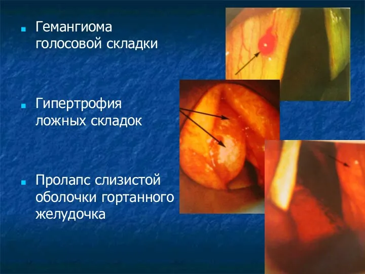 Гемангиома голосовой складки Гипертрофия ложных складок Пролапс слизистой оболочки гортанного желудочка