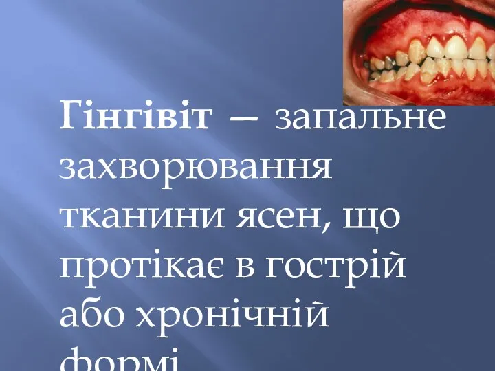 Гінгівіт — запальне захворювання тканини ясен, що протікає в гострій або хронічній формі.