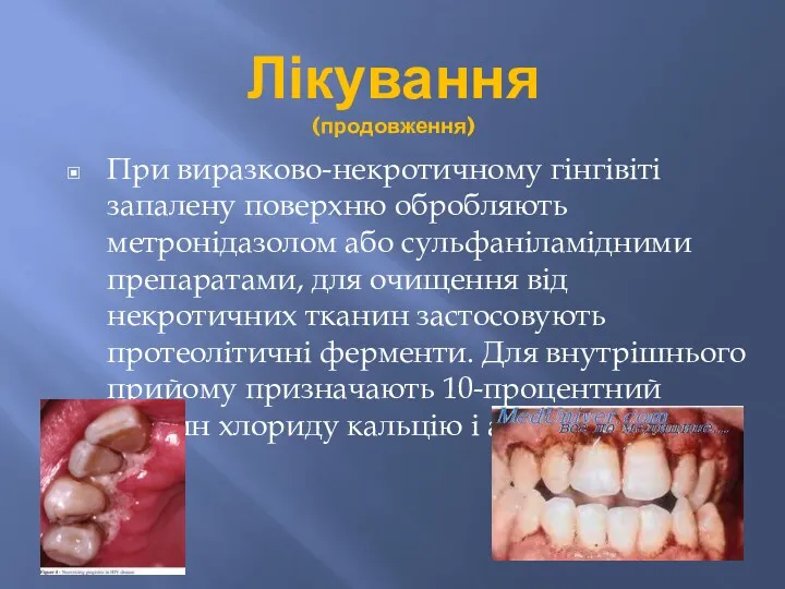 Лікування (продовження) При виразково-некротичному гінгівіті запалену поверхню обробляють метронідазолом або