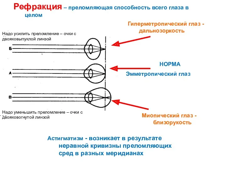 Рефракция – преломляющая способность всего глаза в целом Гиперметропический глаз