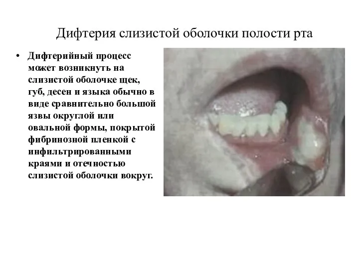 Дифтерия слизистой оболочки полости рта Дифтерийный процесс может возникнуть на
