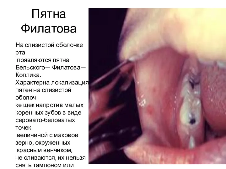 Пятна Филатова На слизистой оболочке рта появляются пятна Бельско­го— Филатова—