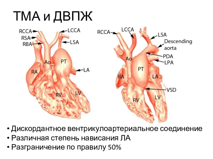 ТМА и ДВПЖ Дискордантное вентрикулоартериальное соединение Различная степень нависания ЛА Разграничение по правилу 50%