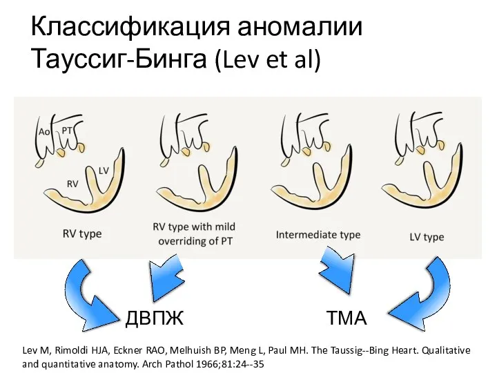 Классификация аномалии Тауссиг-Бинга (Lev et al) ДВПЖ ТМА Lev M,