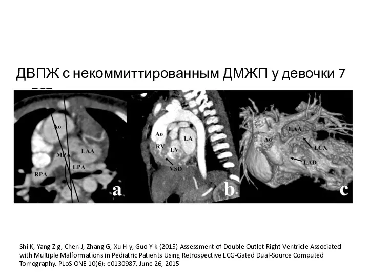 ДВПЖ с некоммиттированным ДМЖП у девочки 7 лет Shi K,