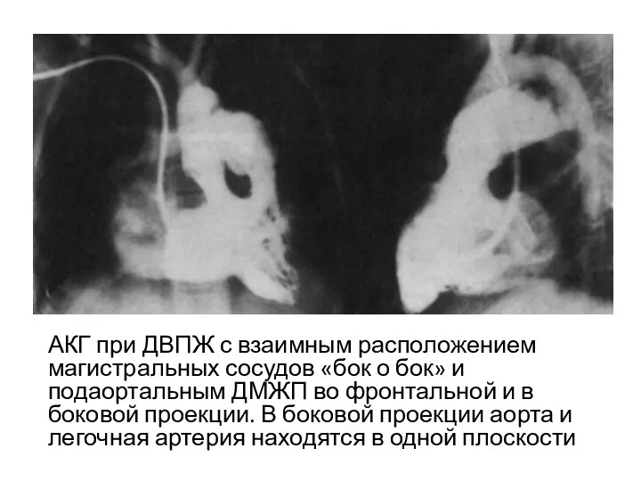 АКГ при ДВПЖ с взаимным расположением магистральных сосудов «бок о