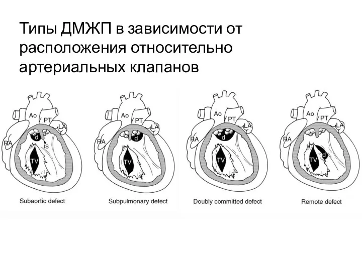 Типы ДМЖП в зависимости от расположения относительно артериальных клапанов