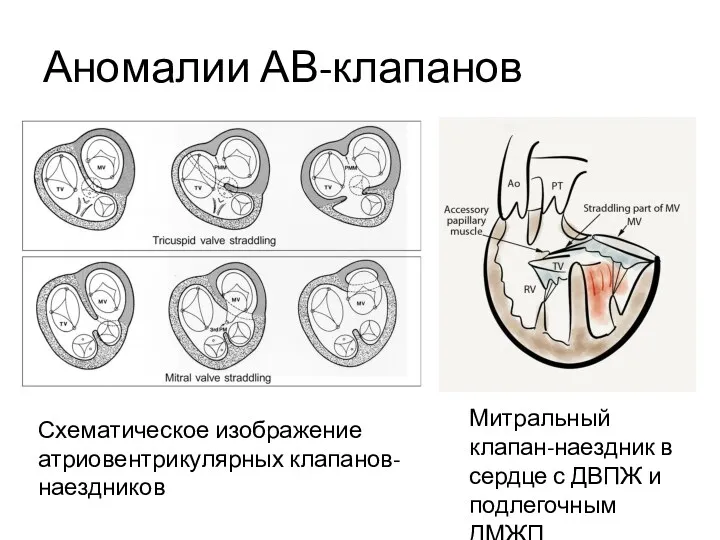 Аномалии АВ-клапанов Митральный клапан-наездник в сердце с ДВПЖ и подлегочным ДМЖП Схематическое изображение атриовентрикулярных клапанов-наездников