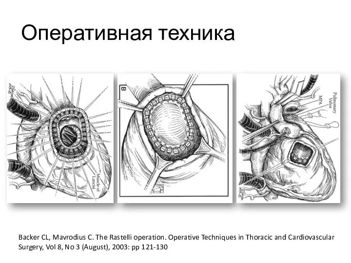 Оперативная техника Backer CL, Mavrodius C. The Rastelli operation. Operative