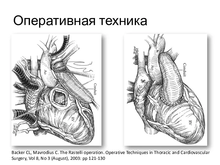 Оперативная техника Backer CL, Mavrodius C. The Rastelli operation. Operative