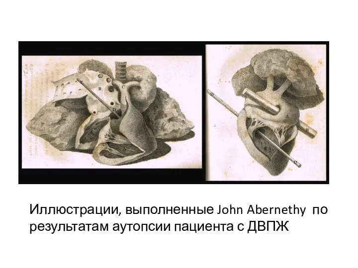 Иллюстрации, выполненные John Abernethy по результатам аутопсии пациента с ДВПЖ